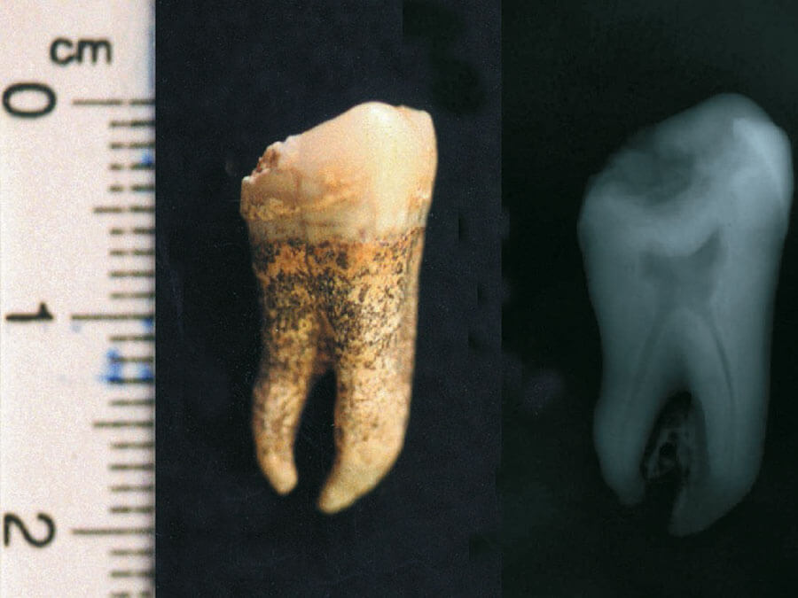 Intact teeth extracted from three randomly selected dead in the Kerameikos mass grave